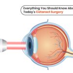Best Cataract Surgery in KPHB Kukatpally | Medivision