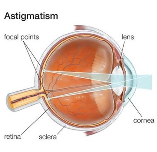 ASTIGMATISM